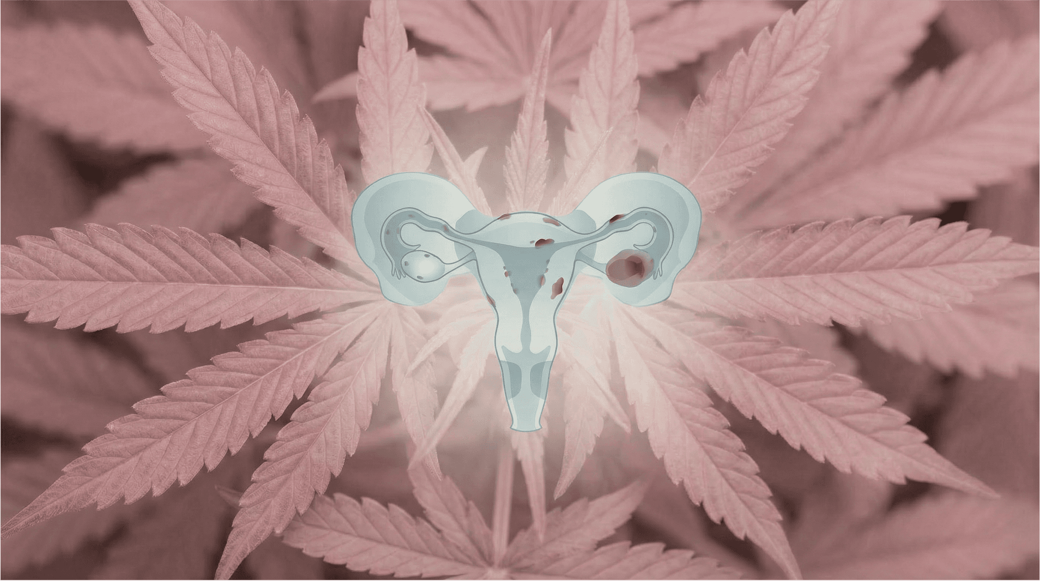 Abstrakte medizinische Illustration der Gebärmutter mit Eileitern und Eierstöcken, auf der dunkelrote Endometriose-Herde sichtbar sind, vor einem Hintergrund aus rosa Cannabisblättern – symbolisch für den Zusammenhang zwischen medizinischem Cannabis und Endometriose.